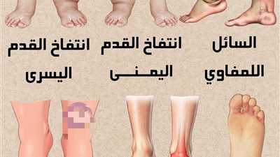  السائل اللمفاوي