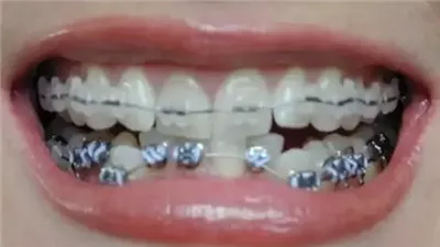 لماذا نهى النبي عن التفلج خاصة النساء وما معنى التفلج 
