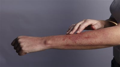 اذا لاحظتها توجه للطبيب فوراً علامة على الجلد تشير إلى الاصابة بنوع خبيث من السرطان