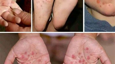فيروس جديد ينتشر يسبب انتشار الحبوب على جسم الأطفال