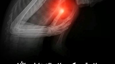 علامة يمكن ملاحظتها في الأذن قد تتنبأ بالنوبة القلبية