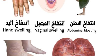  انتفاخ البطن