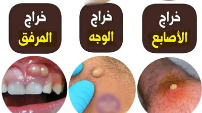  خراج الأصابع بسبب عدوى بكتيرية، تقليم الأظافر بشكل خاطئ